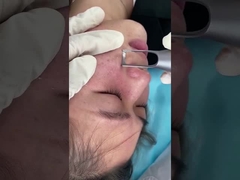 Máy Laser Picosecond Salon 1064nm 532nm để điều trị các vấn đề về sắc tố da