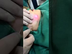 Máy cắt giảm mỡ bằng laser 1470nm chuyên nghiệp Kết quả có thể nhìn thấy trong 2-3 buổi